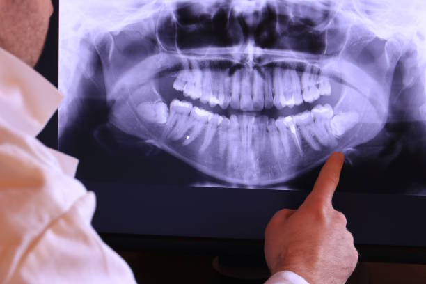 Best Emergency Wisdom Teeth Removal in Elk Ridge, UT